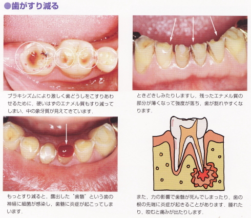 歯の変化