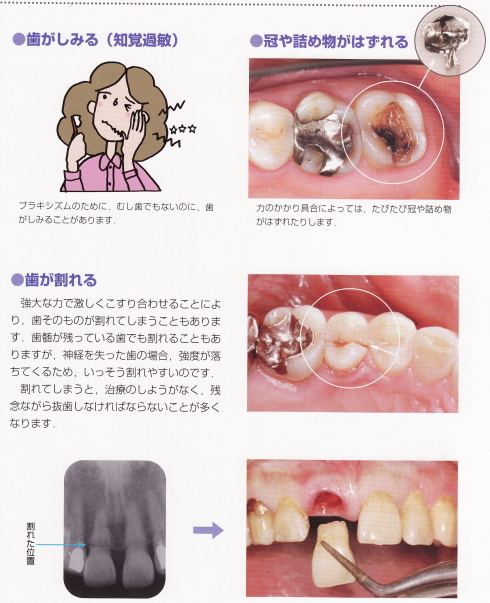 歯がしみる　冠や詰め物がはずれる、歯が割れる