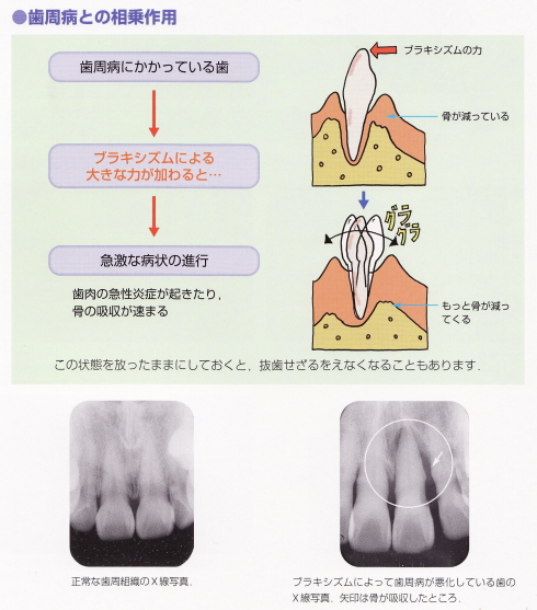 歯周病と相乗作用