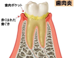 歯肉炎