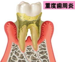 重度歯周炎