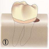 歯の横の部分の骨が一部、一方向のみ、少量無くなった状態