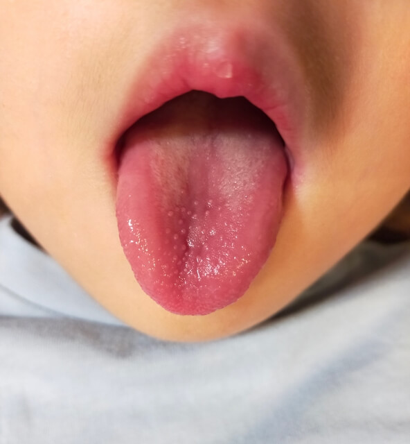 子どもの歯並びと舌の癖
